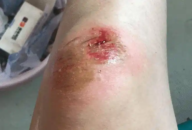 邵阳俩美女教师摔伤真是为孩子们操碎了心