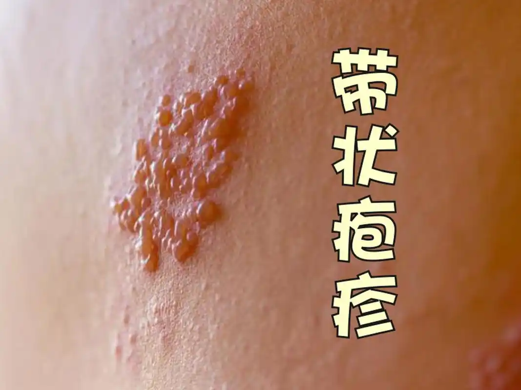 但带状疱疹又不仅仅是个皮肤病,水痘-带状疱疹病毒是一种具有传染性的