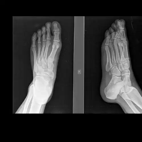 请教各位10765右足正斜位片