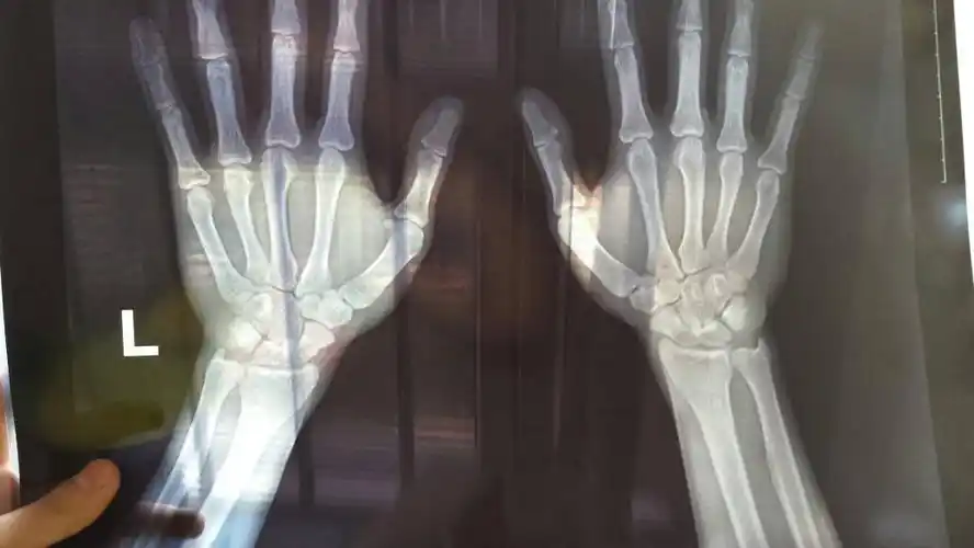 医生请帮忙认真看下骨骺线闭合没,非常感谢,顺便问一下,要怎么看?