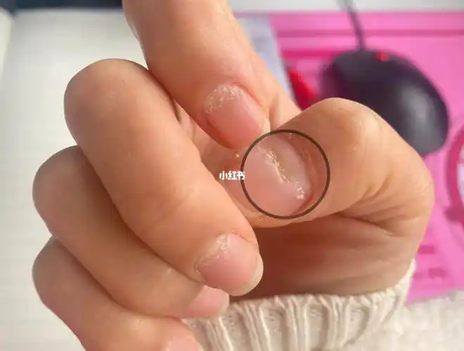 密恐慎点十个手指甲起泡凹陷