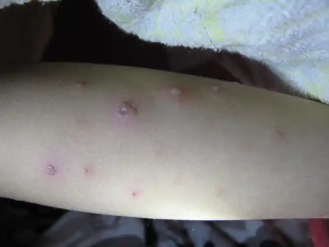 可怜的孩子全身斑丘疹骚痒伴小水疱求解