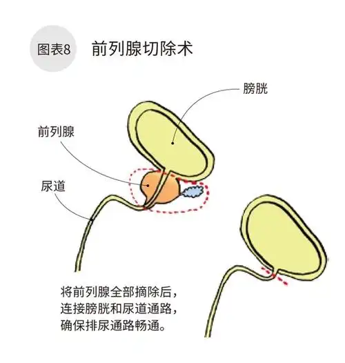 前列腺癌手术治疗有哪些方法?