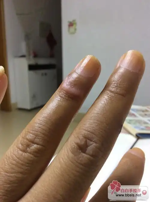 手上皮肤照灯角质很厚,除了抹喜辽妥之外,还可以早卤米松,晚爱宁达吗?