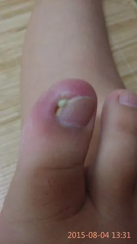 脚趾头痛感觉肿了一点,而且化脓了,按下就会痛这是怎么了?怎么样会好?