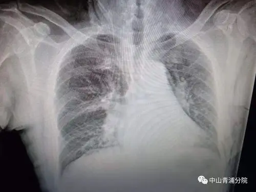 医生带你看病例科学认识肺结节