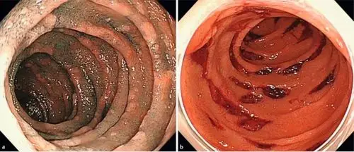 endoscopy: 冷圈套切除家族性腺瘤性息肉病患者十二指肠腺瘤安全性的