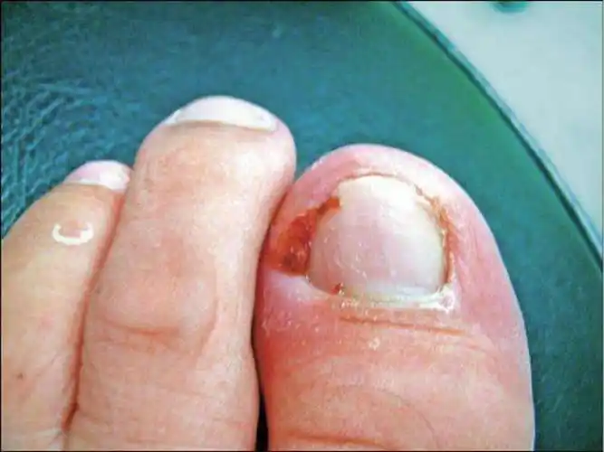 甲沟炎的诊断和鉴别甲周炎的图片