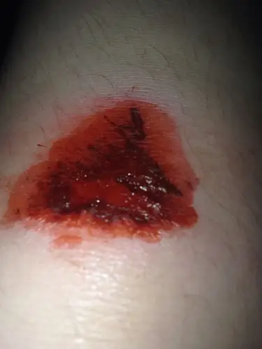 脚摔成这样几天会好?要注意什么?能碰水吗