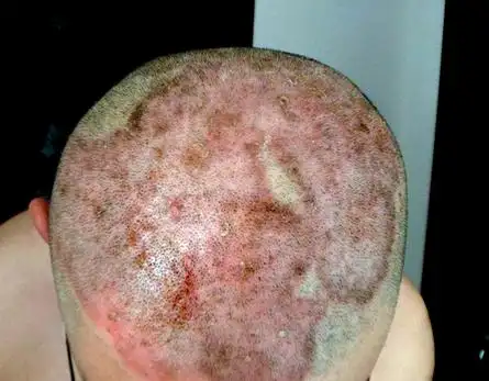 头部是牛皮癣的常发部位,很多患者都是头部先出现牛皮癣的症状.