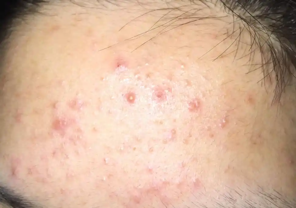 为什么脸上 会突然狂长痘痘?