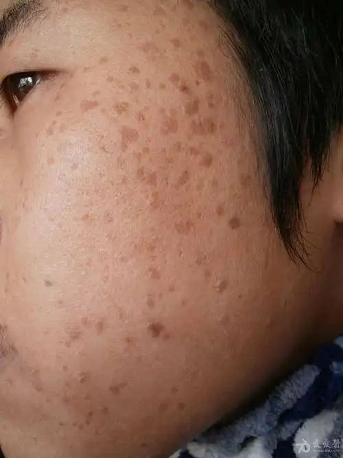 典型病例扁平疣