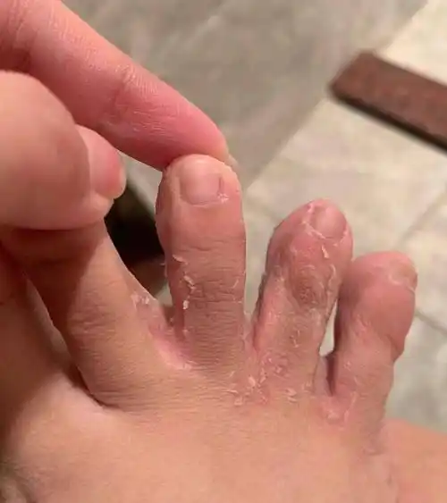 脚气的高发期到了,脚丫又痒又难闻,这样做脚气能断根?_严重_时候_用药