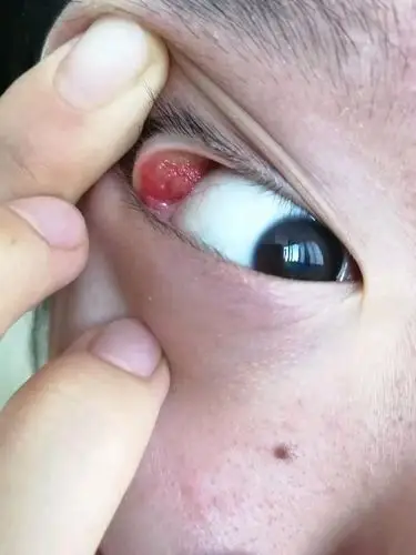 正文不想修行: 回复 mhwmhz :谢谢楼主 医生说是麦粒肿引起的并发炎症