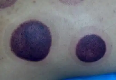 拔罐后罐印的颜色所代表的含义都是什么|脏腑|湿气|治疗|寒热_网易