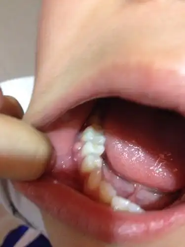 牙龈上长一肉包,不痛不痒.