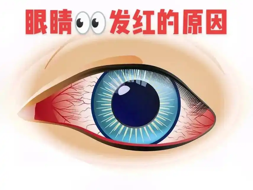 眼睛98发红的原因 - 抖音