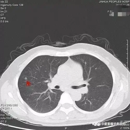 实性肺结节的影像诊断是真的挺难,更需要全面细致
