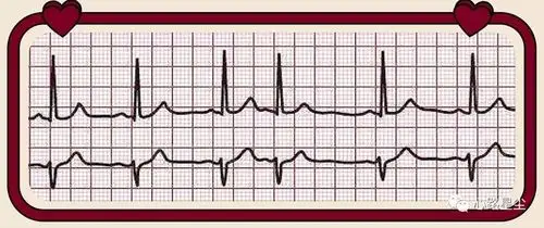 健康科普丨体检发现早搏怎么办是心脏病的前兆吗