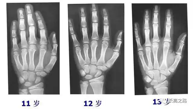 教你简单识别孩子的骨龄片