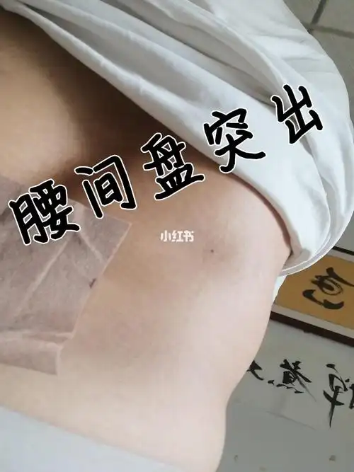 我治疗腰间盘突出的选择_腰间盘突出_医疗健康_医疗药品