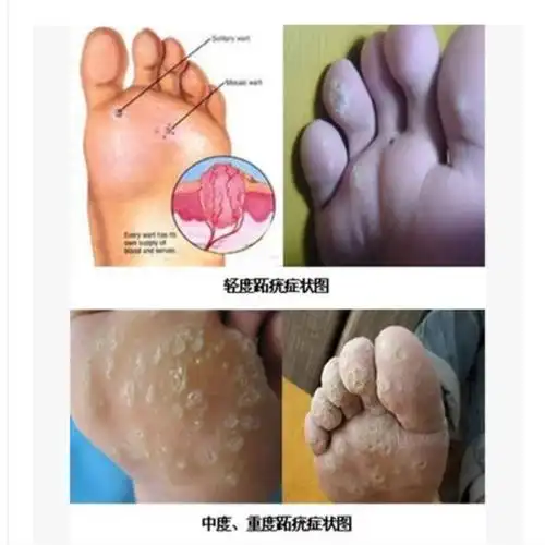 共139 件刺猴跖疣相关商品