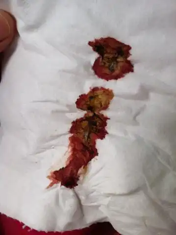 常见于痔疮,肛裂等,但是除了痔疮,肛裂外还有溃疡性结肠炎,直肠息肉