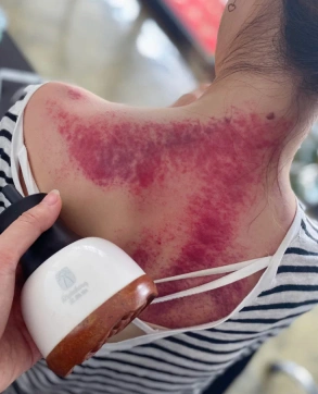 第一次尝试刮痧,让同事帮我弄的,出这么多痧是不是过分了!太吓人了