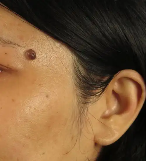 🗯️ 容易癌变的痣