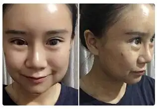 注射溶脂针对比照