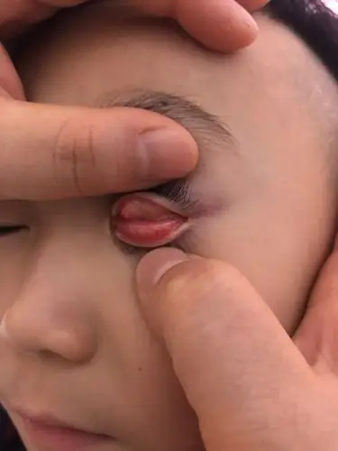 宝宝眼睛这是怎么了?求教