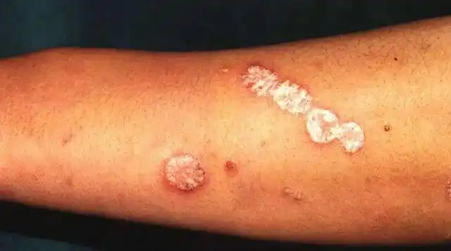 龟头上长银屑病的图片