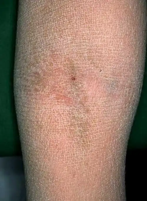 角样鱼鳞病图片_有来医生