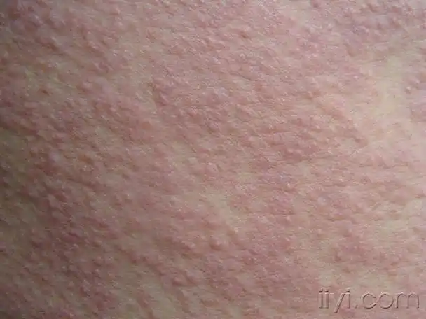 表现为面部的炎性丘疹,脓疱头皮密集毛囊性炎性丘疹,中央脓疱,周围