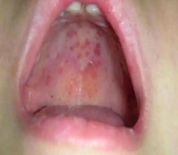 小孩子手足口病手部症状图片_有来医生