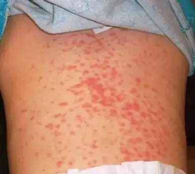 当服药后出现皮疹