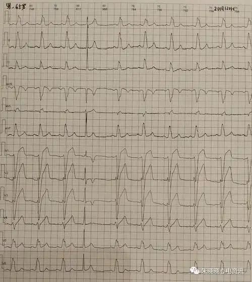 卢老师看心电图-- 左束支阻滞伴早搏波形正常化 2019-12-1