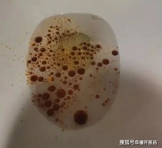 最常见的副作用:引起油性便或油性斑点便,胃肠胀气,腹部不适,大便紧急