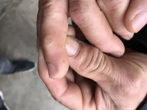 分享一例手指皮肤病损