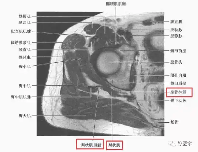 sg:上孖肌,oi:闭孔内肌,ig:下孖肌 二,梨状肌解剖 1,梨状肌 梨状肌起