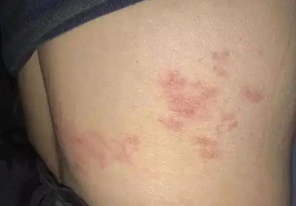 原创带状疱疹缠腰蛇痛起来如刀割医生这些人易患可这样治疗