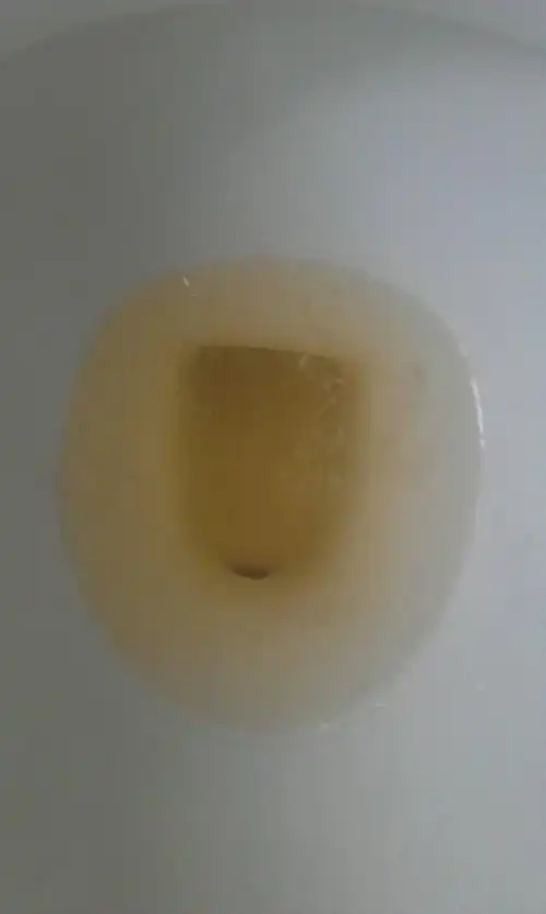 尿液有很多泡泡,一段时间后大部分消失,但仍有部分,同时有白色漂浮物.