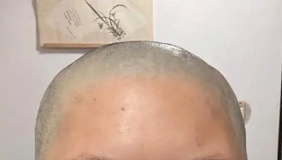 头发稀少怎么变浓密|头发稀少发丝细软,剃光头能改善?_我爱问答