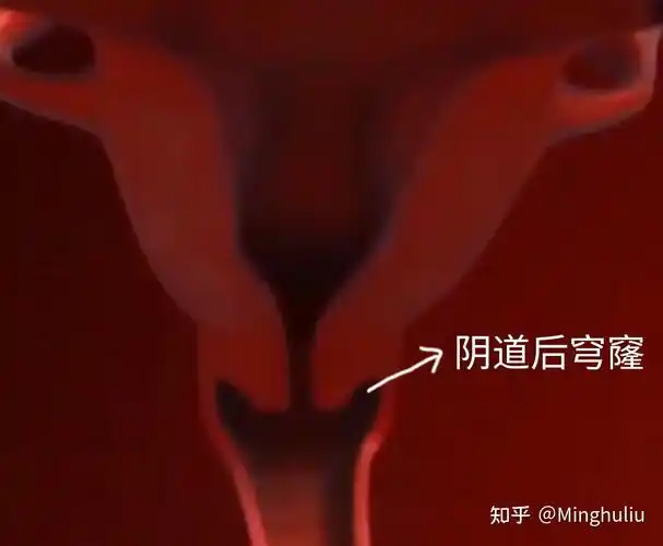 如图,大概在这里:在同房时,精液会射到一个叫"阴道后穹窿"的位置.