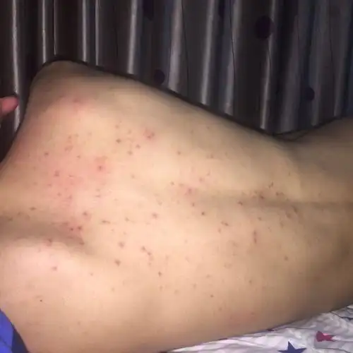后背上长痘痘 有三四年了 也没掉 一直也没理他 现在发现严重了 这是