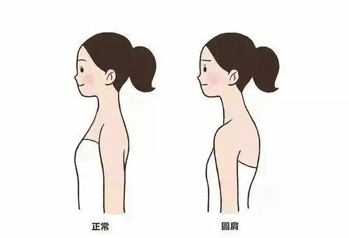 肩膀内扣成为了当下常见体态为什么会出现了解正确的解决动作