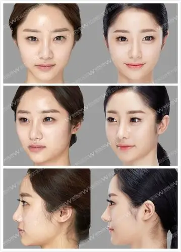 韩国原辰鼻综合手术真人案例分享 隆鼻教父名不虚传