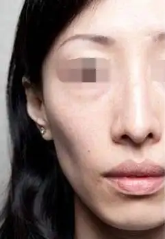 面部凹陷不饱满怎么办