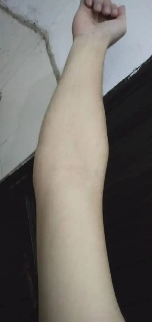 这个肘外翻严重吗,能去当兵吗