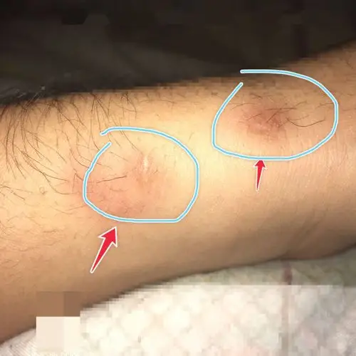 手臂上这个伤疤能消除吗?